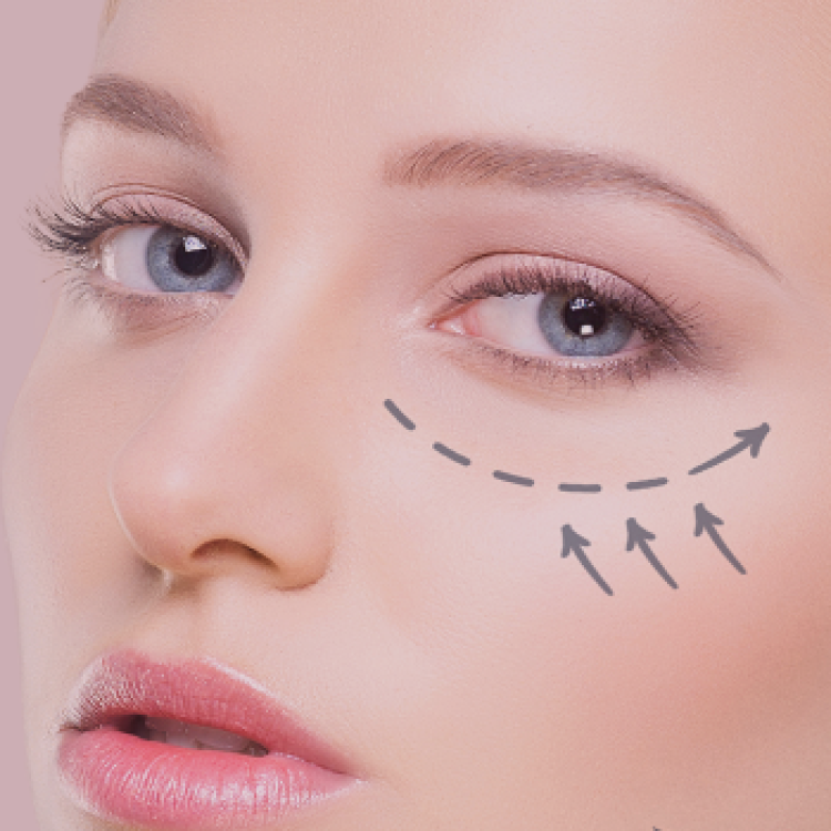 Blefaroplastia